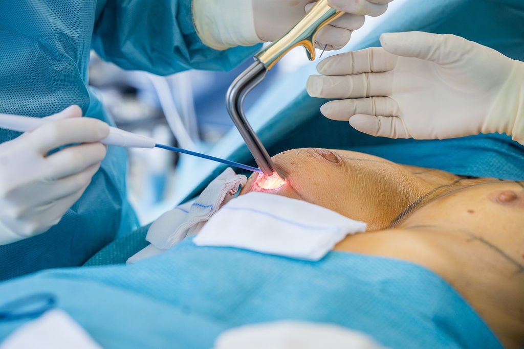 déroulement de l'opération d'augmentation mammaire