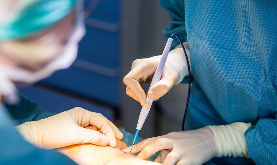 déroulement de l'opération d'abdominoplastie