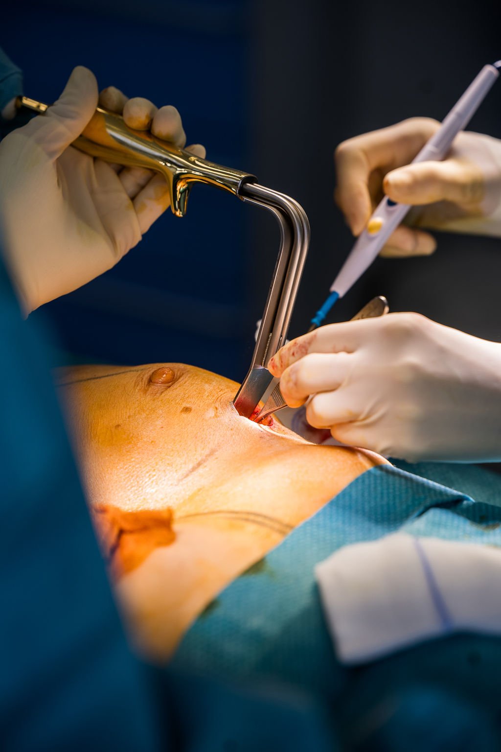 déroulement de l'opération d'augmentation mammaire