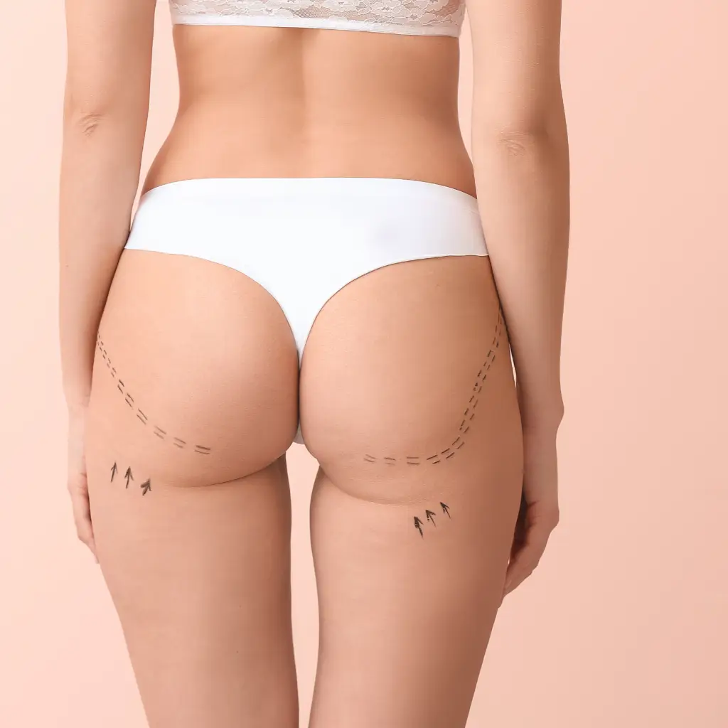Marquages chirurgicaux sur les fesses avant opération esthétique