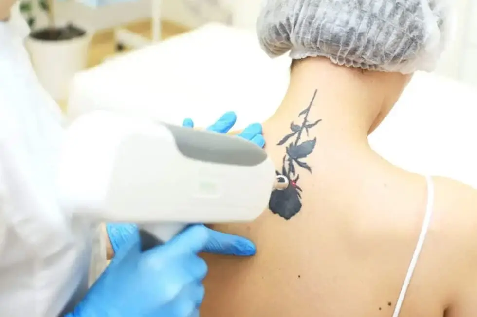 Suppression laser d’un tatouage sur la nuque.