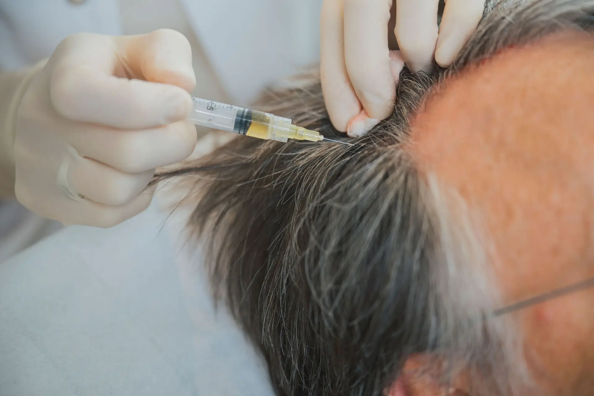 Injection capillaire pour traitement de la chute de cheveux
