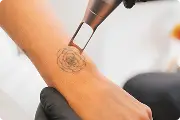 Suppression de tatouage au laser sur la peau