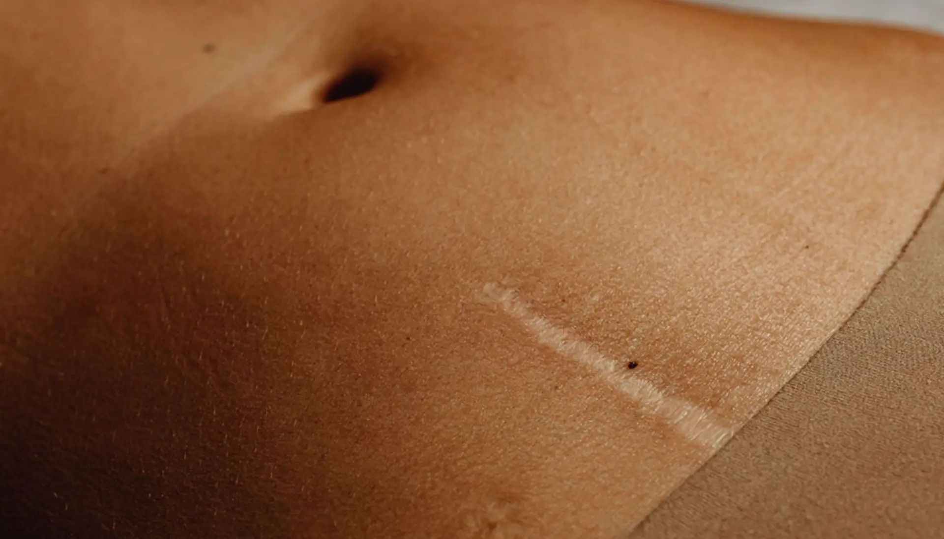 Cicatrice sur la peau du ventre