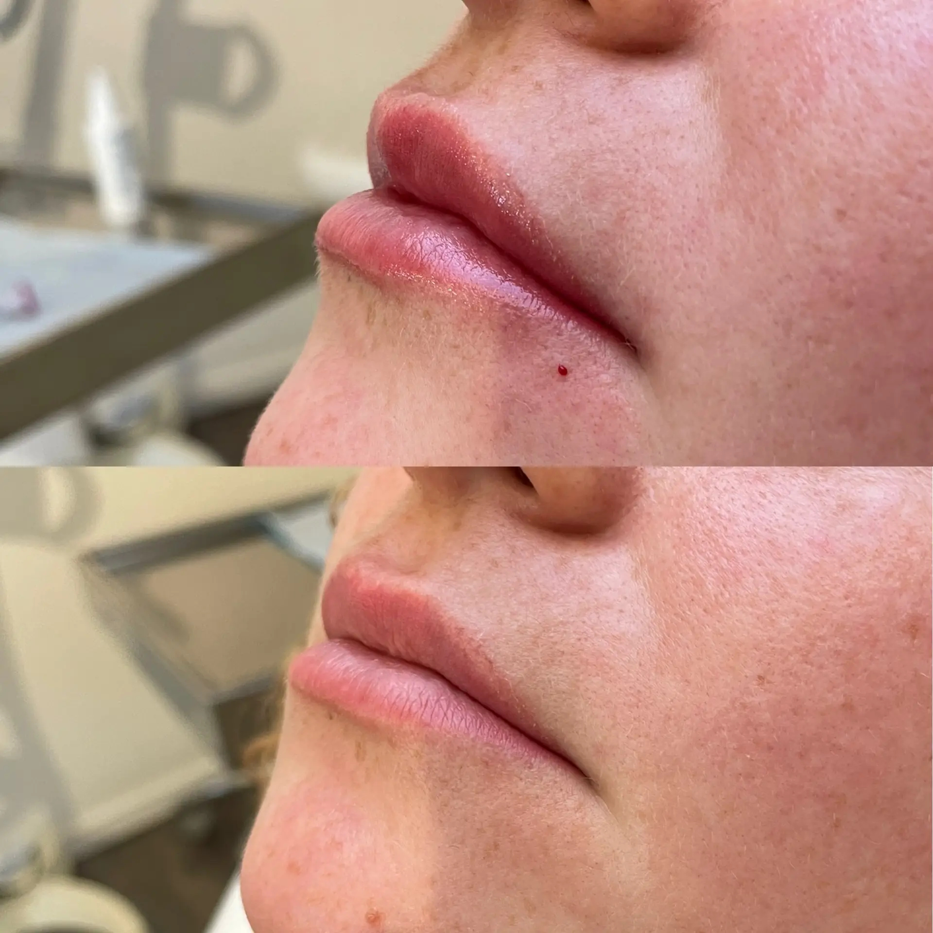 résultat des injections d'acide hyaluronique