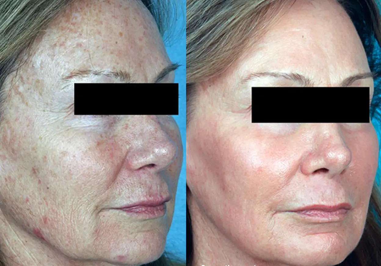 résultat du Laser co2 